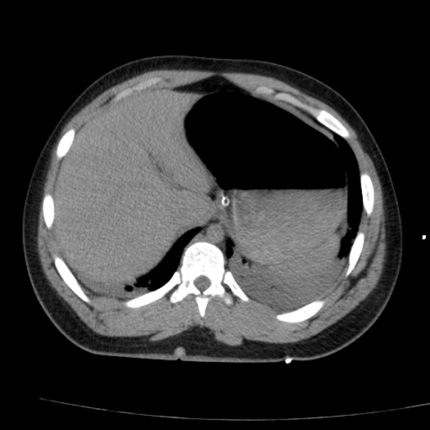 Acute aspiration pneumonitis (Radiopaedia 33605-34703 Axial non-contrast 74).jpg
