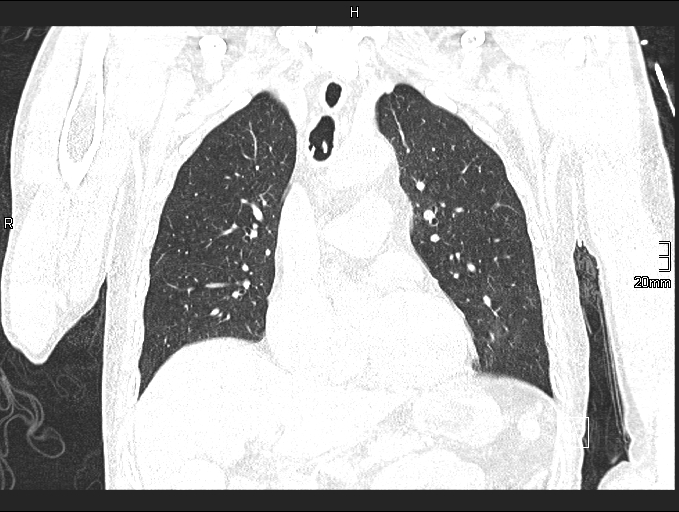 Acute aspiration pneumonitis (Radiopaedia 55642-62166 Coronal lung window 41).jpg
