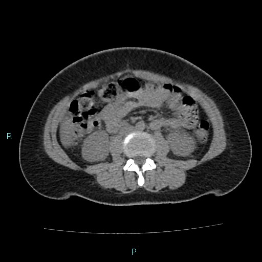 Acute bilateral pyelonephritis (Radiopaedia 37146-38881 Axial non-contrast 55).jpg