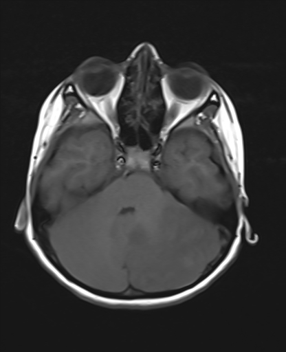 File:Acute cerebellar ataxia (Radiopaedia 61487-69446 Axial T1 6).jpg