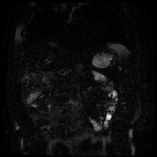 Acute cholecystitis and biliary hamartomas (Radiopaedia 86231-102240 E 131).jpg
