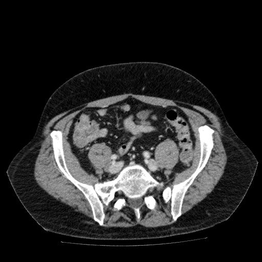 File:Acute cholecystitis and incidental left sided IVC (Radiopaedia 49352-54459 Axial C+ portal venous phase 112).jpg