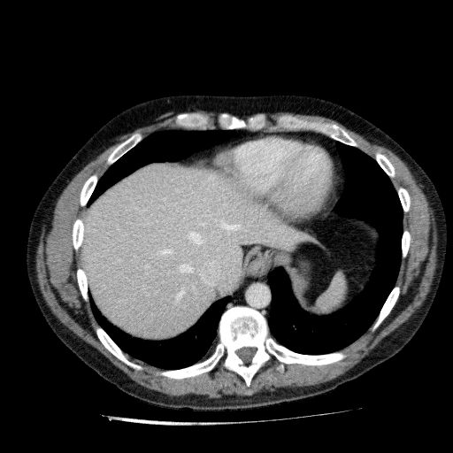 File:Acute cholecystitis and incidental left sided IVC (Radiopaedia 49352-54459 Axial C+ portal venous phase 28).jpg