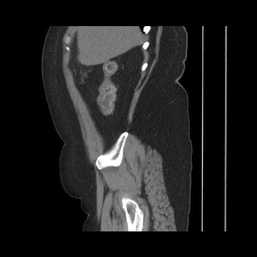 Acute cholecystitis with tensile fundus sign (Radiopaedia 71394-81723 Sagittal non-contrast 46).jpg