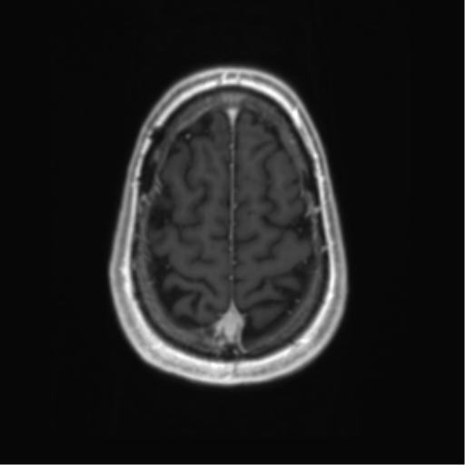 Acute disseminated encephalomyelitis (ADEM) (Radiopaedia 65319-74350 Axial T1 C+ 57).png