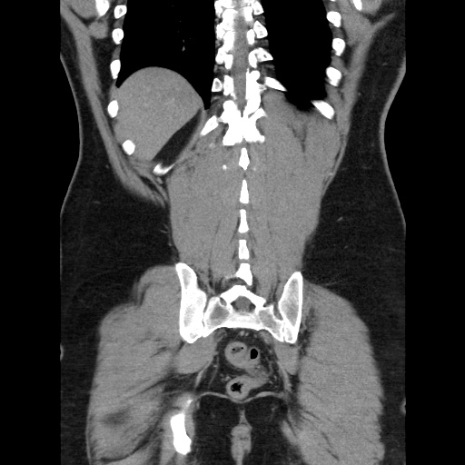 File:Acute diverticulitis with localized perforation (Radiopaedia 41296-44113 Coronal C+ portal venous phase 51).jpg