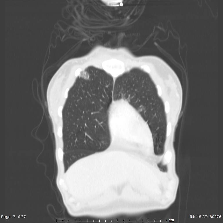 Acute eosinophilic pneumonia (Radiopaedia 48211-53073 Coronal lung window 3).jpg
