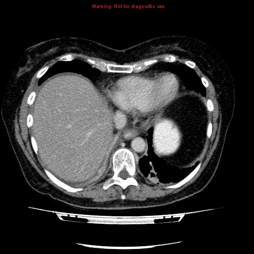 Acute gangrenous cholecystitis (Radiopaedia 10123-10661 Axial C+ portal venous phase 11).jpg