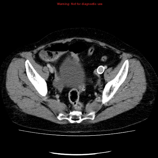 Acute gangrenous cholecystitis (Radiopaedia 10123-10661 Axial C+ portal venous phase 86).jpg