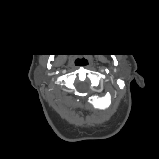 File:Acute internal carotid artery dissection (Radiopaedia 53541-59630 D 3).jpg