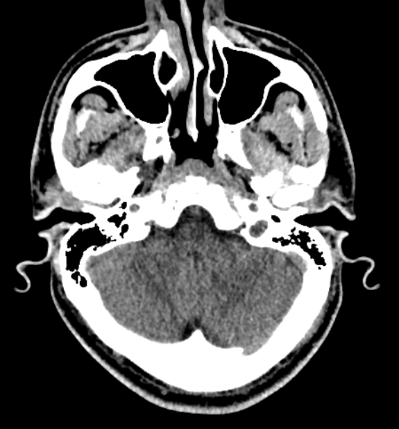 Acute ischemic stroke - posterior circulation territory (Radiopaedia 77670-89881 non-contrast 15).jpg