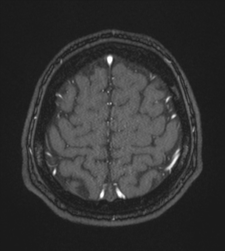 Acute left middle cerebral artery territory infarct with clot retrieval (Radiopaedia 47732-52433 Axial MRA 58).png