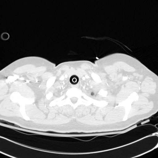 Acute myocardial infarction in CT (Radiopaedia 39947-42415 Axial lung window 4).jpg