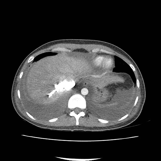 Acute myocarditis (Radiopaedia 55988-62613 Axial C+ portal venous phase 10).jpg