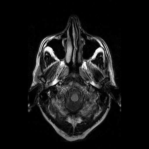 File:Acute necrotizing toxoplasma encephalitis (Radiopaedia 10683-11149 Axial FLAIR 17).jpg