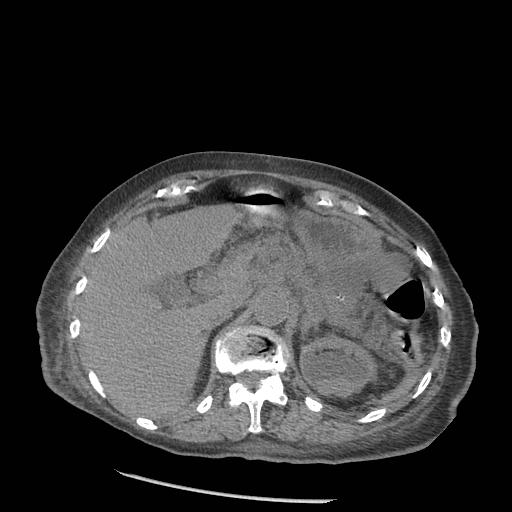 Acute on chronic pancreatitis (Radiopaedia 13233-13244 Axial non-contrast 21).jpg