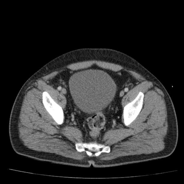Acute pancreatitis (Radiopaedia 26663-26813 Axial C+ portal venous phase 75).jpg