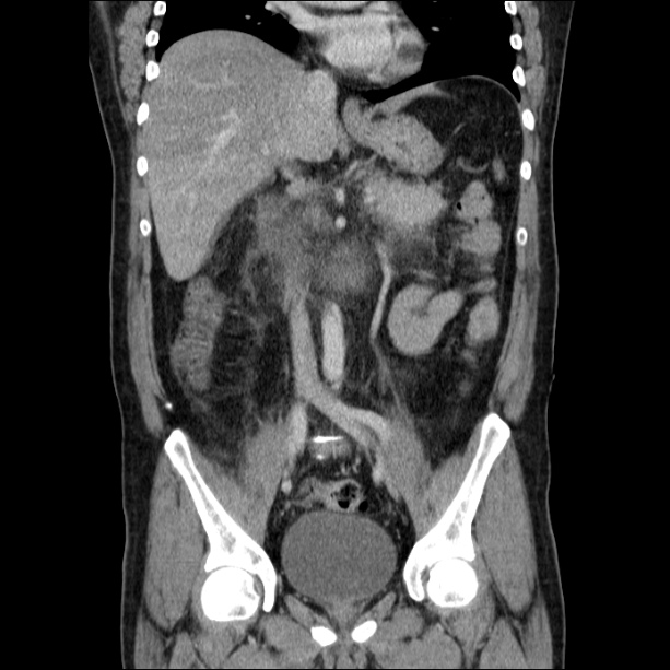 Acute pancreatitis (Radiopaedia 26663-26813 Coronal C+ portal venous phase 35).jpg