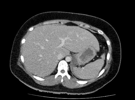 Acute pancreatitis (Radiopaedia 69236-79012 Axial C+ portal venous phase 21).jpg