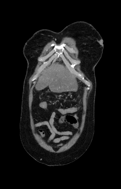 Acute pancreatitis (Radiopaedia 80007-93285 Coronal C+ portal venous phase 12).jpg