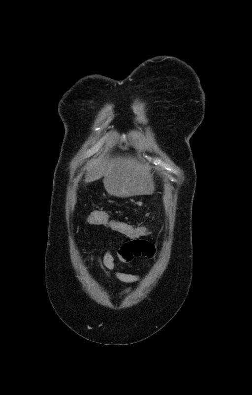 Acute pancreatitis (Radiopaedia 80007-93285 Coronal C+ portal venous phase 2).jpg