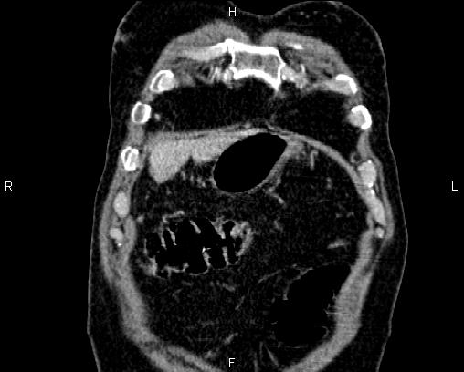 Acute pancreatitis (Radiopaedia 85146-100701 Coronal C+ portal venous phase 5).jpg