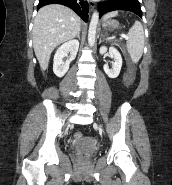 Acute pancreatitis - Balthazar E (Radiopaedia 29016-29377 Coronal C+ portal venous phase 60).png
