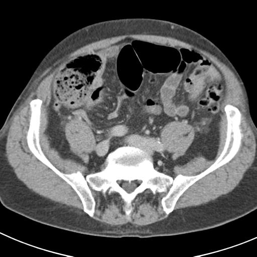 Acute pancreatitis and walled-off necrosis (Radiopaedia 29888-30403 Axial C+ delayed 61).jpg
