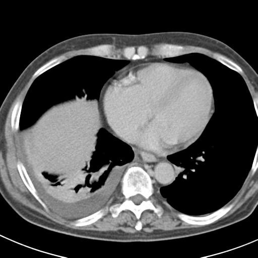 Acute pancreatitis and walled-off necrosis (Radiopaedia 29888-30403 Axial C+ delayed 7).jpg