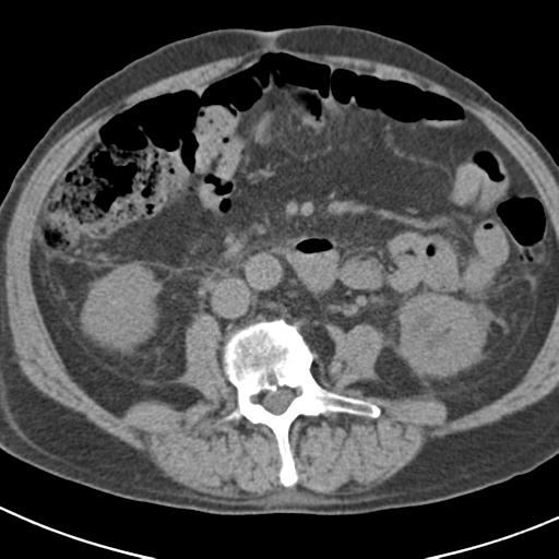 File:Acute pancreatitis and walled-off necrosis (Radiopaedia 29888-30403 Axial non-contrast 38).jpg