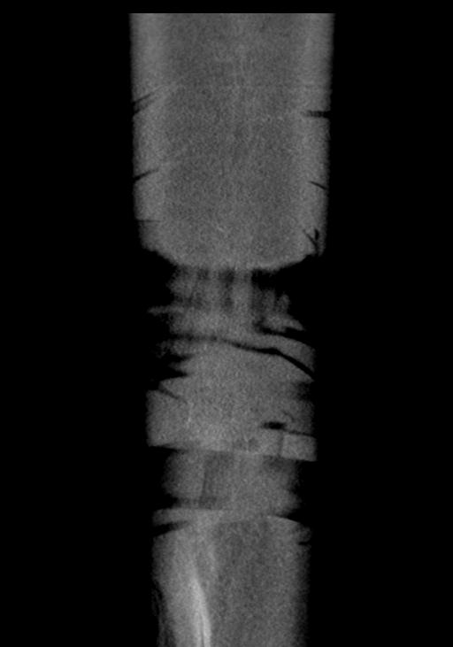 Acute pancreatitis and walled-off necrosis (Radiopaedia 29888-30403 E 55).jpg
