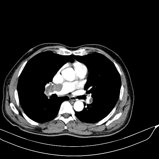 Acute pulmonary embolism (Radiopaedia 69510-79390 D 15).jpg