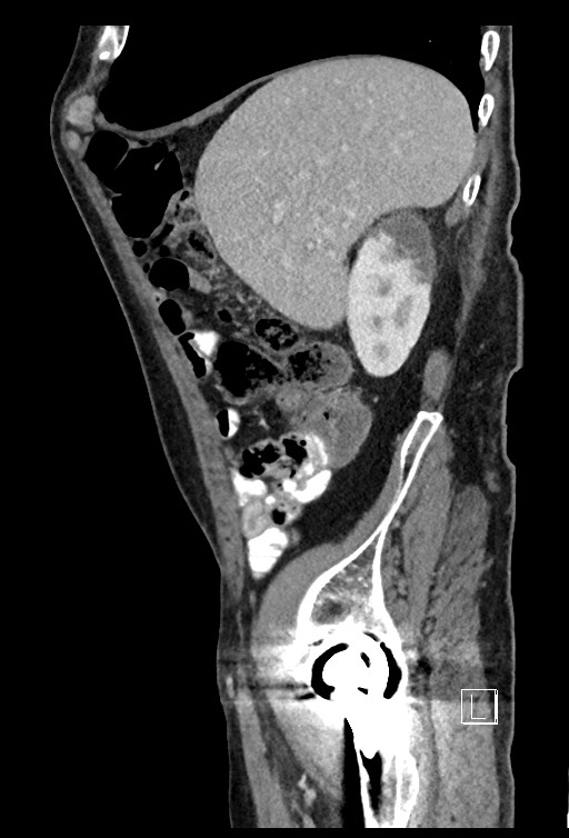 Acute renal infarction - rim capsular enhancement (Radiopaedia 59833-67270 Sagittal C+ portal venous phase 70).jpg