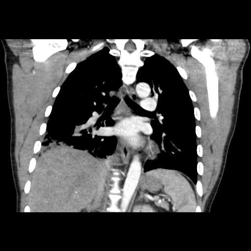 Acute segmental pulmonary emboli and pulmonary infarction (Radiopaedia 62264-70444 Coronal C+ CTPA 32).jpg
