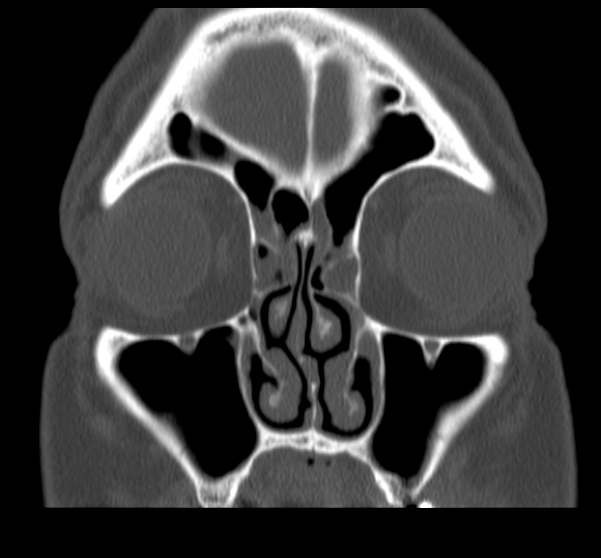 Acute sinusitis (Radiopaedia 23161-23215 Coronal bone window 27).jpg