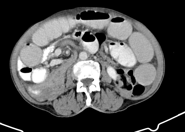 Acute small bowel (ileal) volvulus (Radiopaedia 71740-82139 Axial C+ portal venous phase 107).jpg