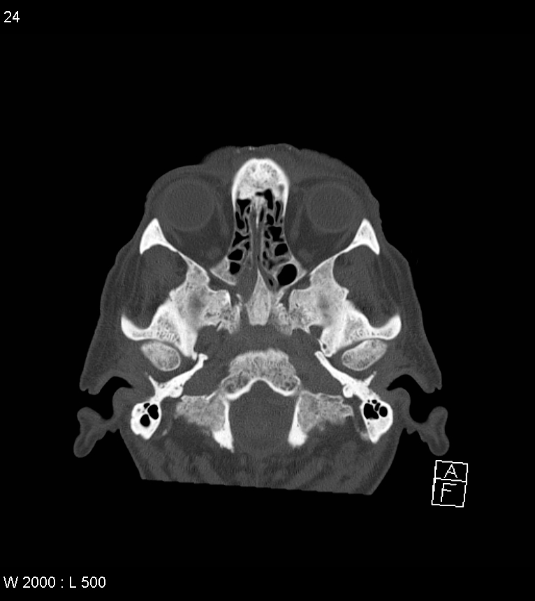 Acute subdural hematoma with myelofibrosis (Radiopaedia 52582-58494 Axial bone window 12).jpg