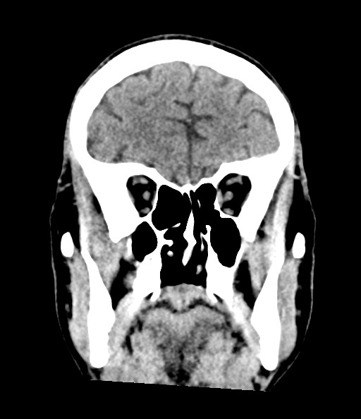 Acute superior cerebellar artery territory infarct (Radiopaedia 84104-99359 Coronal non-contrast 33).jpg