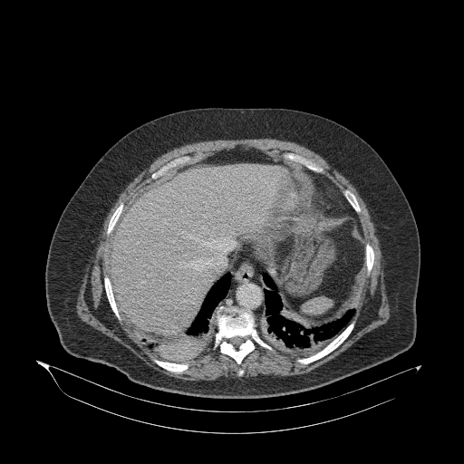 Acute superior mesenteric artery occlusion (Radiopaedia 51288-56960 Axial C+ portal venous phase 13).jpg