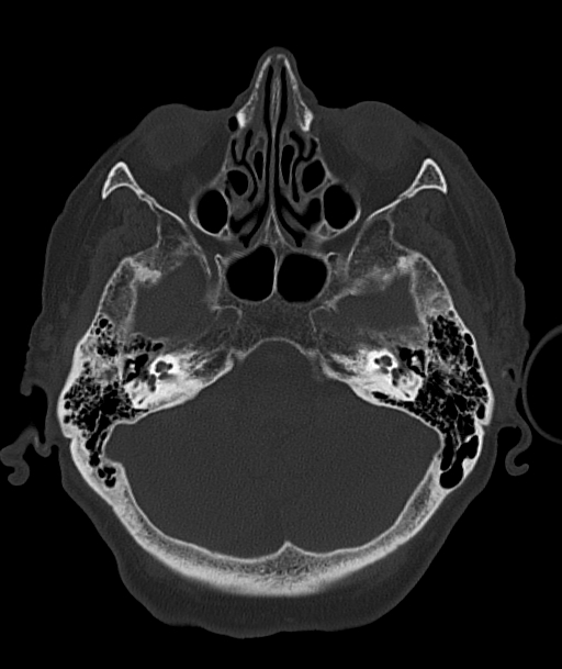 Acute traumatic subdural hematoma (Radiopaedia 82921-97257 Axial bone window 82).jpg