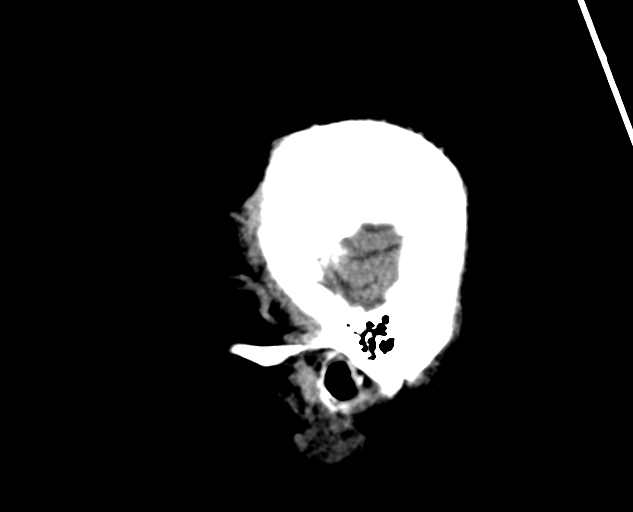 Acute traumatic subdural hematoma (Radiopaedia 82921-97257 Sagittal non-contrast 65).jpg