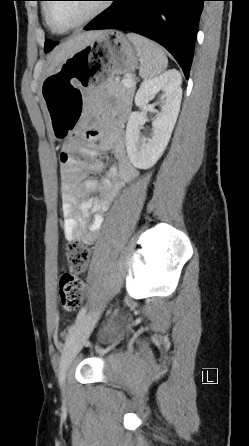 Acute uncomplicated appendicitis (Radiopaedia 61374-69304 Sagittal C+ portal venous phase 32).jpg