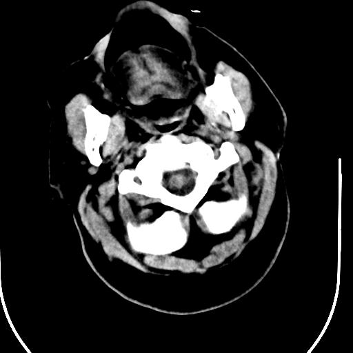 File:Acute vertebrobasilar ischemic infarction (Radiopaedia 25220-25473 Axial non-contrast 3).jpg