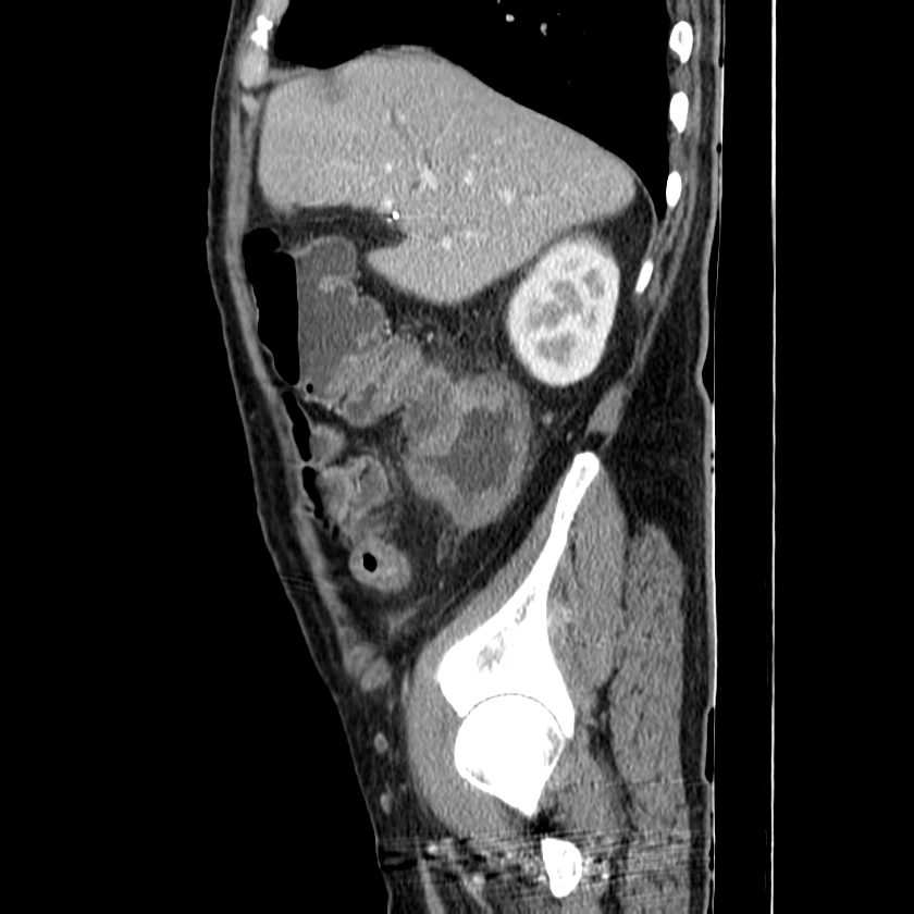 Adenocarcinoma of colon with entero-colic fistula (Radiopaedia 22832-22852 Sagittal C+ portal venous phase 16).jpg