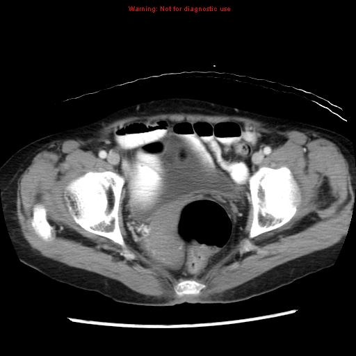 Adenocarcinoma of the colon (Radiopaedia 8191-9039 Axial liver window 69).jpg