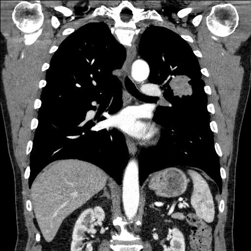 Adenocarcinoma of the lung (Radiopaedia 59871-67325 Coronal C+ arterial phase 41).jpg