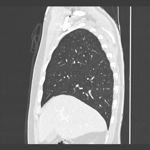 Adenocarcinoma of the lung (Radiopaedia 59871-67325 Sagittal lung window 21).jpg