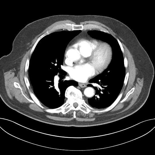 File:Adenocarcioma of rectum- T1 lesion (Radiopaedia 36921-38547 Axial C+ arterial phase 32).png
