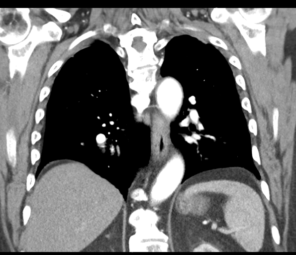 Adenocarcioma of rectum- T1 lesion (Radiopaedia 36921-38547 Coronal C+ arterial phase 42).png