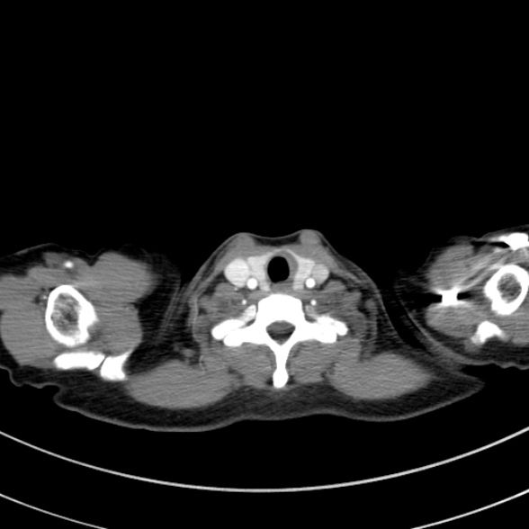 Adenocystic carcinoma of the trachea (Radiopaedia 47677-52525 Axial C+ arterial phase 26).jpg